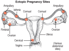 ectopic-preg
